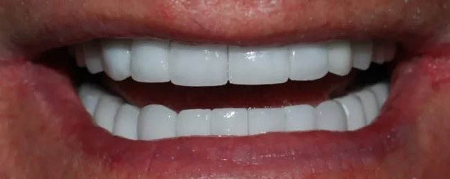 A close-up photograph of a bright, confident smile showcasing perfectly aligned, uniform white upper and lower teeth.