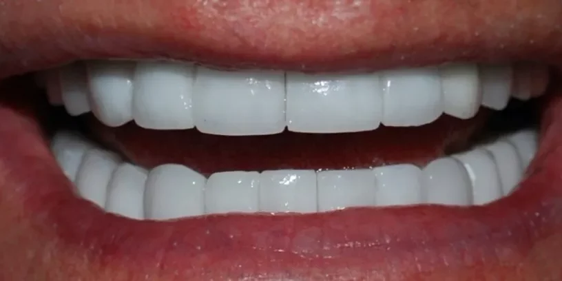 A close-up photograph of a bright, confident smile showcasing perfectly aligned, uniform white upper and lower teeth.