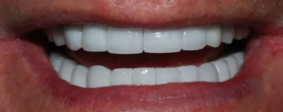 A close-up photograph of a bright, confident smile showcasing perfectly aligned, uniform white upper and lower teeth.
