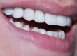 A close-up photograph of a smiling mouth showcasing bright, clean upper and lower teeth.