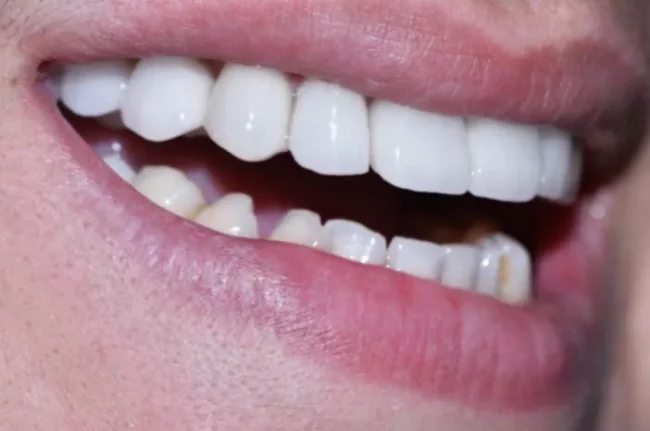 A close-up photograph of a smiling mouth showcasing bright, clean upper and lower teeth.