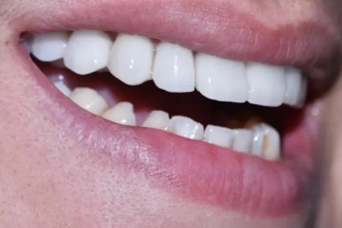 A close-up photograph of a smiling mouth showcasing bright, clean upper and lower teeth.