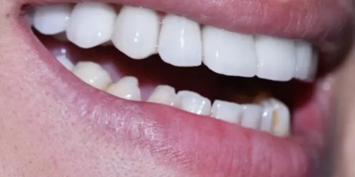 A close-up photograph of a smiling mouth showcasing bright, clean upper and lower teeth.