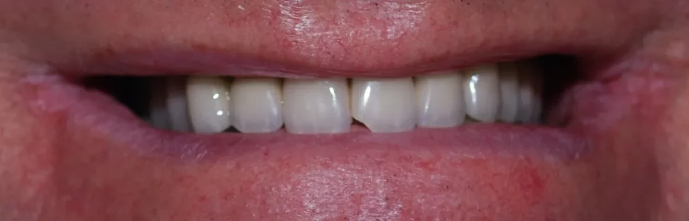 A close-up photograph of a person's smile displaying evenly aligned and natural-looking upper teeth.