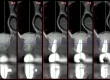Series of five dental CT cross-section images labeled with measurement values, showing sequential slices through a tooth and surrounding bone.