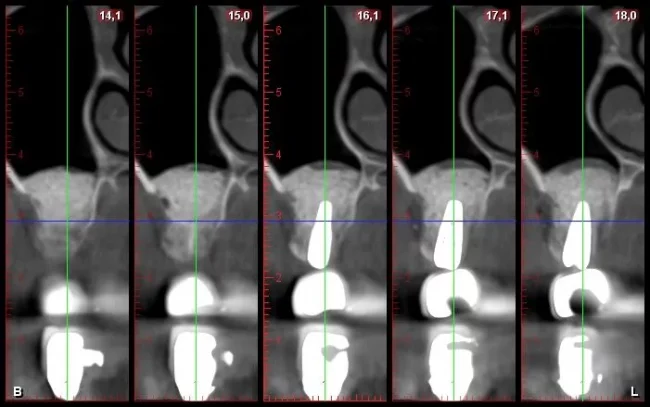 Series of five dental CT cross-section images labeled with measurement values, showing sequential slices through a tooth and surrounding bone.