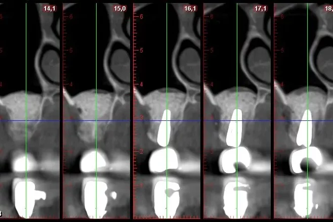 Series of five dental CT cross-section images labeled with measurement values, showing sequential slices through a tooth and surrounding bone.