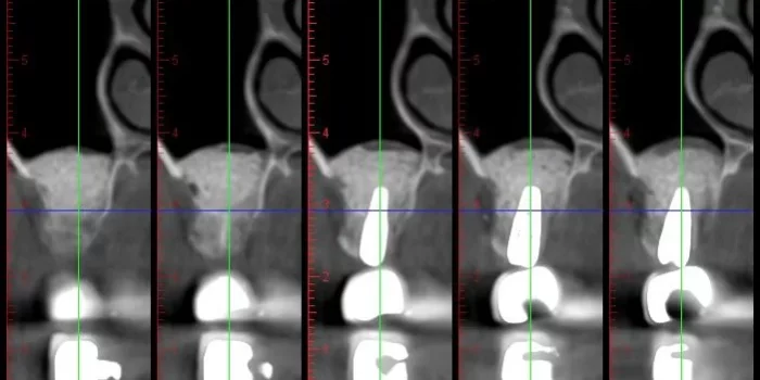 Series of five dental CT cross-section images labeled with measurement values, showing sequential slices through a tooth and surrounding bone.