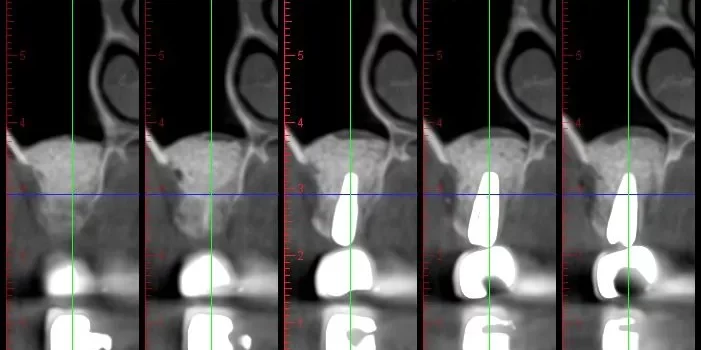 Series of five dental CT cross-section images labeled with measurement values, showing sequential slices through a tooth and surrounding bone.