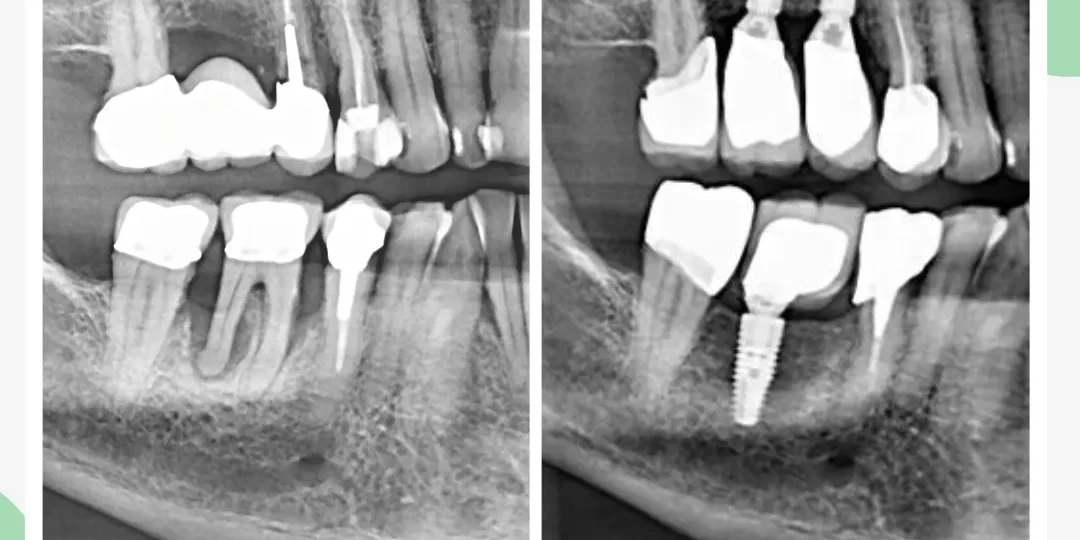 Side-by-side dental X-rays labeled "Avant" and "Apres," showing a tooth implant treatment with visible dental implants placed in the "Apres" image.