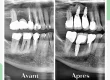 Side-by-side dental X-rays labeled "Avant" and "Apres," showing a tooth implant treatment with visible dental implants placed in the "Apres" image.