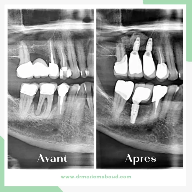 Side-by-side dental X-rays labeled "Avant" and "Apres," showing a tooth implant treatment with visible dental implants placed in the "Apres" image.