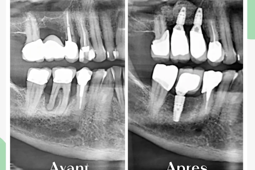 Side-by-side dental X-rays labeled "Avant" and "Apres," showing a tooth implant treatment with visible dental implants placed in the "Apres" image.